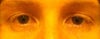 Both eyes