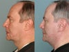 before photo is on left and after photo on right.