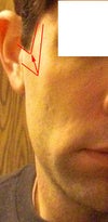 Red line indicates proposed incisions for skin-only lift.