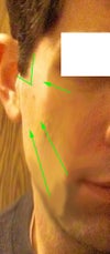 Green lines indicate direction of correction - at the "skin only" level due to excess skin.