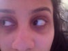 This is the front view of my dark circles showcasing the darkness and hollowness.