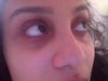 Side view and more apparent view of the tear trough darkness as well as indentation.  Also to note, my left tear trough is increasingly more indented than the right one which I suppose would be something to account for if I go w/ an HA filler