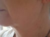 wrinkles cheeks lips wanting a aggresive treatment to help reduce these areas