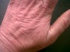 Damage to hands one year post Fraxel RePair