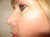 after revision hump under nose