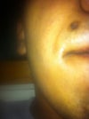 this is the black spot that appeared after the mole fell of.