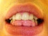 Overbite