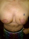 front view 10 days post op
