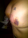 left - 10 days post op
