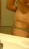Skin bulges over my incisions on my sides