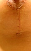 left me a skin tag under my right breast