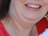 Chin & Neck area BEFORE surgery