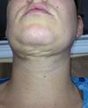 Front view 27 days post op