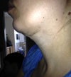 left profile 27 days post op
