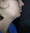 right profile 27 days post op