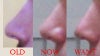 From left to right, how my nose was, how it is now and how I want it to be, from the side.