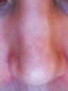 frontal view, I wanted a slimmer tip..he also filled up a gap..I had a bit of a hispanic nose, he did a good job on that, but the left side is flatter than the right side, makes it uneven.