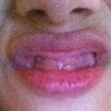 Sorry, this picture isn't very attractive.. but under my lip, that line of fat. I'm hiding my teeth purposely.