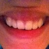 This is my natural smile. Normally, I tighten my lip a little to hide it. My top lip is really large. Is it because of the fat or my actual tubercle?
