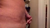 my buldge at upper and pubic area