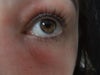 Deep crepey wrinkles appeared