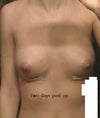 Two days post op, 34C 325cc. They look small and far apart, nipples set low, look like a-b cups