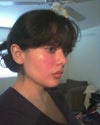 right after Radiesse (swollen)