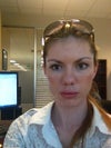 After Radiesse treatment yesterday.