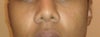 front view of nose. my right nostril (left when looking at it on screen) is asymmetrical because deviated septum pushed nasal bone out.