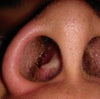 photo of deviated septum pushing against right nasal bone