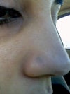This is the scar that I have right now, I would just like to know on average how much it would be to get this removed?