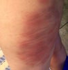 bruising after velashape pic 1