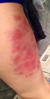bruising after velashape pic 2