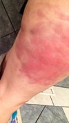 bruising after velashape pic 3
