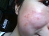 i peel it after putting aspirin .. but still the left skin turned red