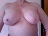 Original incision was in areola and surgeon (now retired), mis-judged, and so had to cut on either side of nipple to insert implant.