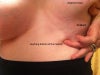 Pushing on bottom of implant - left breast