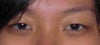 Eyes before surgery