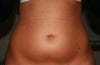 before lipo belly