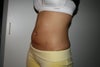 after lipo belly