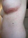 After removing outer coating of dermabond, incision site improved, no further blistering. on 4th day of pred pack. rash starting to spread again. Could this be a dermabond allergy? He said that he used it inside the incision and then coated the outside. How long would this take to resolve? Does the body just absorb the dermabond? She is not using soaps, laudry det. or lotions. Really getting worried that she is developing some kind of allergy to the implant. Is this possible? It seems the more time that is going by, it is getting worse instead of better.