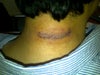 Photo showing incision. 7 days after surgery