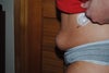 Side view post surgery