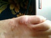 what it looks like, now there is a bump on pinky toe and seems to be spreading up my foot.