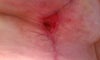 4 weeks post op; stitiches split; hole is getting wider; using silver cel to cover hole and a gauze. right breast at creast; had lollipop procedure