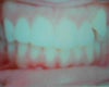 This shows the misalignment and how my teeth shifted to the right because of my canine