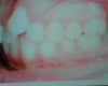 This is the side view which shows my canine and my baby tooth next to it. You can see the size of the gap that I would have after extracting my baby tooth.