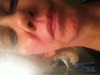 I am so miserable! I can't believe how restylane ruined my face