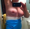 You can see how distorted the breast and implant are, there is not a smooth outline of implant. Someone has suggested rupture...? I feel no scar tissue anywhere in or around the implant.