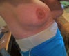 the shadows are outlines of the implant. Its protruding and creating the shadow effects that you can see.